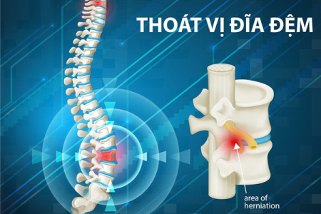 BỆNH THOÁT VỊ ĐĨA ĐỆM CỘT SỐNG LÀ GÌ?